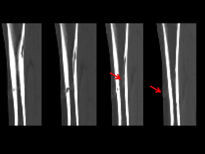 Figure 4 for case varix ( RID3366 )